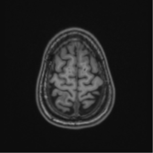 Acute disseminated encephalomyelitis (ADEM) (Radiopaedia 65319-74349 Axial T1 60).png