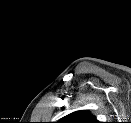 Acute epiglottitis (Radiopaedia 54375-60590 Sagittal C+ arterial phase 77).jpg