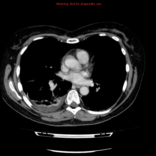 File:Acute gangrenous cholecystitis (Radiopaedia 10123-10661 Axial C+ portal venous phase 2).jpg