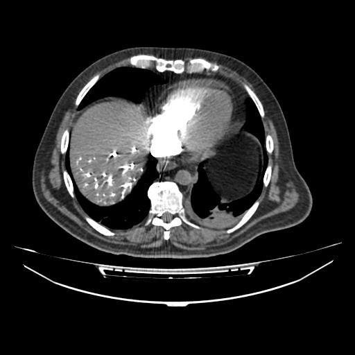 Acute heart failure (CT) (Radiopaedia 79835-93075 Axial C+ arterial phase 48).jpg