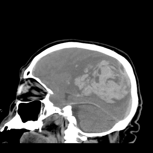 File:Acute hemorrhagic stroke (Radiopaedia 17507-17223 Sagittal non-contrast 16).jpg