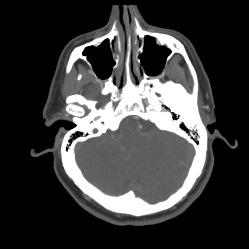 File:Acute internal carotid artery dissection (Radiopaedia 53541-59630 D 18).jpg