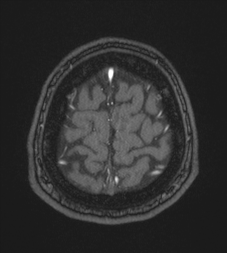 Acute left middle cerebral artery territory infarct with clot retrieval (Radiopaedia 47732-52433 Axial MRA 61).png