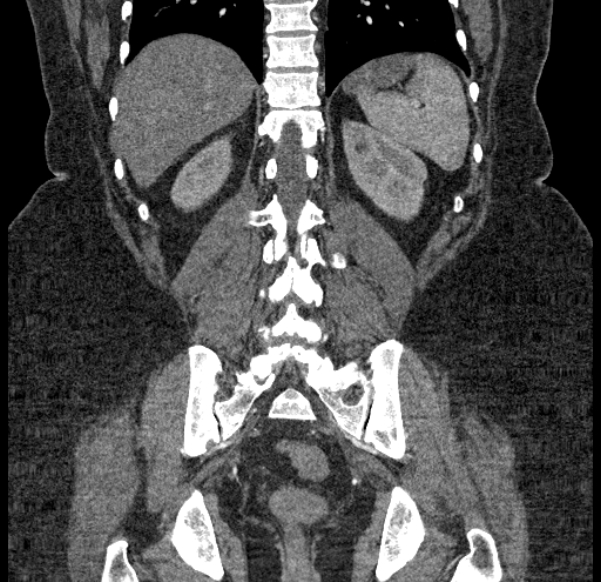 Acute mesenteric ischemia (Radiopaedia 80029-93316 Coronal C+ arterial phase 105).jpg