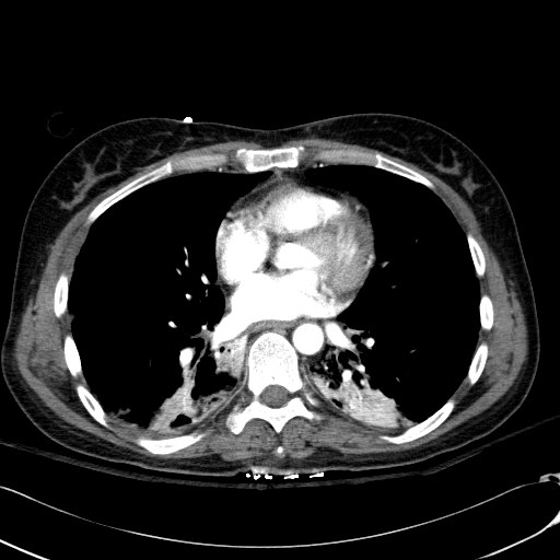Acute myocardial infarction in CT (Radiopaedia 39947-42415 Axial C+ arterial phase 82).jpg