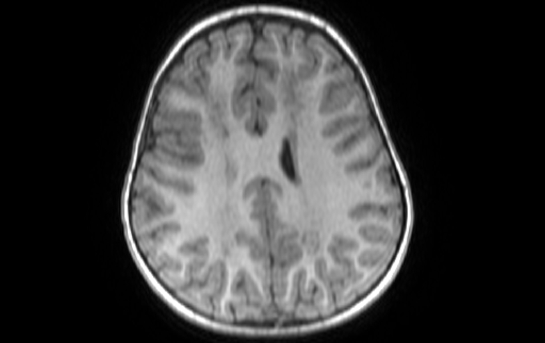 Acute necrotizing encephalitis of childhood (Radiopaedia 67356-76737 Axial T1 30).jpg