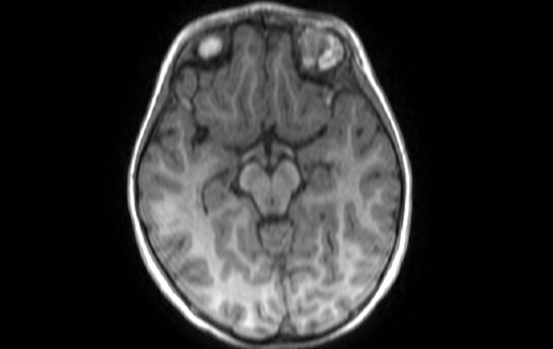 Acute necrotizing encephalitis of childhood (Radiopaedia 67356-76737 Axial T1 57).jpg