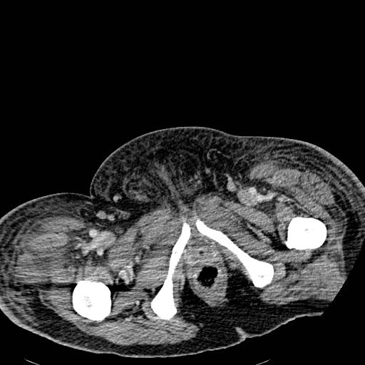 Acute pancreatic necrosis (Radiopaedia 13560-18501 Axial C+ portal venous phase 156).jpg