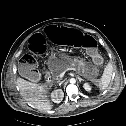 File:Acute pancreatic necrosis (Radiopaedia 13560-18502 Axial C+ portal venous phase 25).jpg