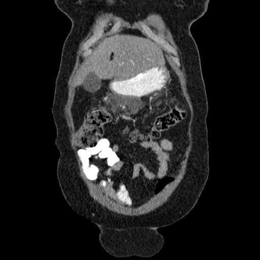 File:Acute pancreatitis (Radiopaedia 20829-20744 Coronal C+ portal venous phase 11).jpg