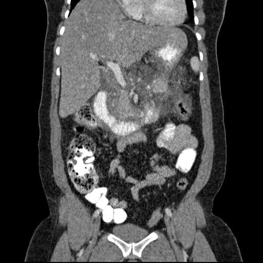 File:Acute pancreatitis (Radiopaedia 20829-20744 Coronal C+ portal venous phase 25).jpg