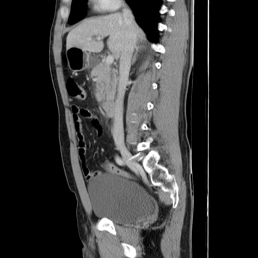 Acute pancreatitis (Radiopaedia 22572-22596 Sagittal C+ portal venous phase 23).jpg