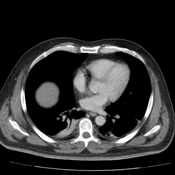 Acute pancreatitis (Radiopaedia 26663-26813 Axial C+ portal venous phase 3).jpg