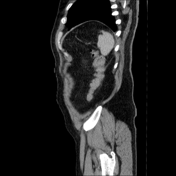Acute pancreatitis (Radiopaedia 26663-26813 Sagittal C+ portal venous phase 66).jpg