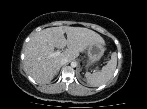 File:Acute pancreatitis (Radiopaedia 69236-79012 Axial C+ portal venous phase 24).jpg