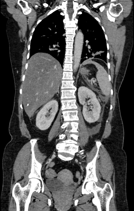 Acute pancreatitis (Radiopaedia 80007-93285 Coronal C+ portal venous phase 101).jpg