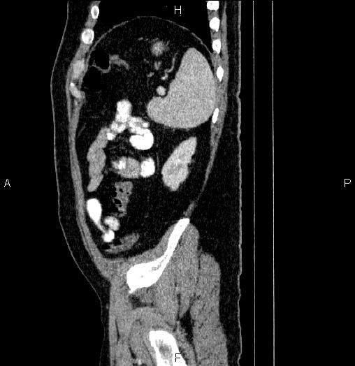 Acute pancreatitis (Radiopaedia 85390-101010 Sagittal C+ portal venous phase 88).jpg