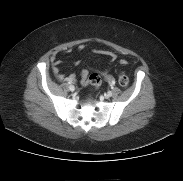 Acute pancreatitis - Balthazar E (Radiopaedia 29016-29377 Axial C+ portal venous phase 57).png