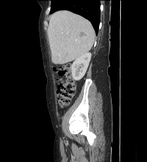 Acute pancreatitis - Balthazar E - post ERCP (Radiopaedia 27562-27772 Sagittal C+ portal venous phase 23).png