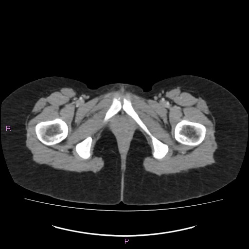 Acute pancreatitis secondary to stone at minor papilla and pancreatic divisum (Radiopaedia 76570-88333 Axial C+ portal venous phase 86).jpg