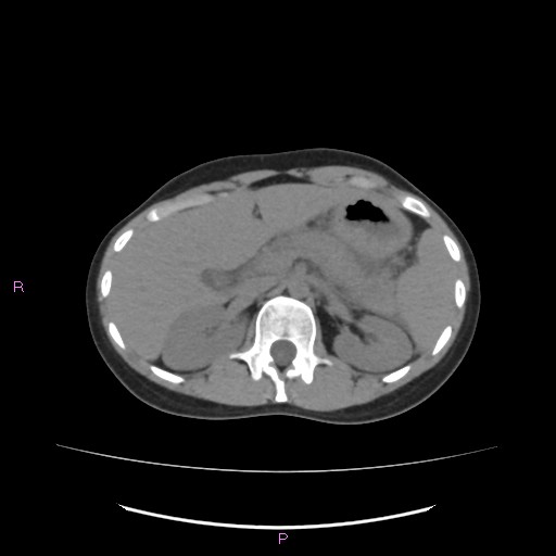 File:Acute pancreatitis secondary to stone at minor papilla and pancreatic divisum (Radiopaedia 76570-88333 Axial non-contrast 23).jpg