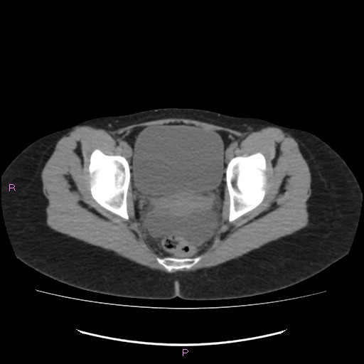 Acute pancreatitis secondary to stone at minor papilla and pancreatic divisum (Radiopaedia 76570-88333 Axial non-contrast 72).jpg