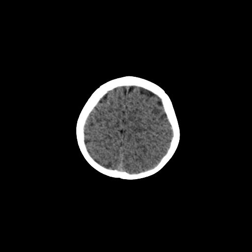 Acute phase of hemiconvulsion-hemiplegia epilepsy syndrome (Radiopaedia 29309-29744 Axial non-contrast 9).jpg
