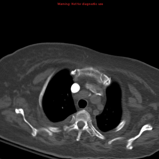 Acute pulmonary embolism (Radiopaedia 13286-13289 Axial C+ CTPA 15).jpg
