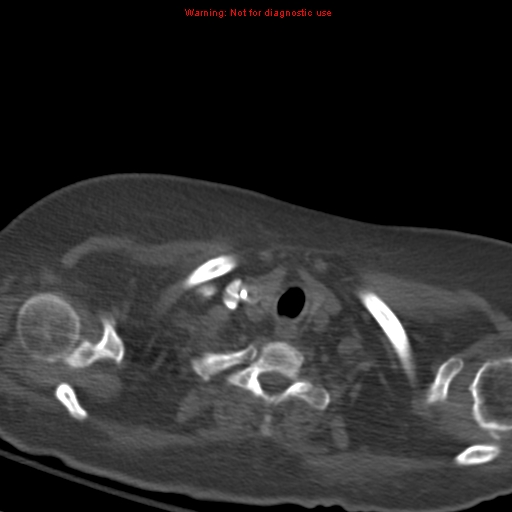 File:Acute pulmonary embolism (Radiopaedia 13286-13289 Axial C+ CTPA 4).jpg