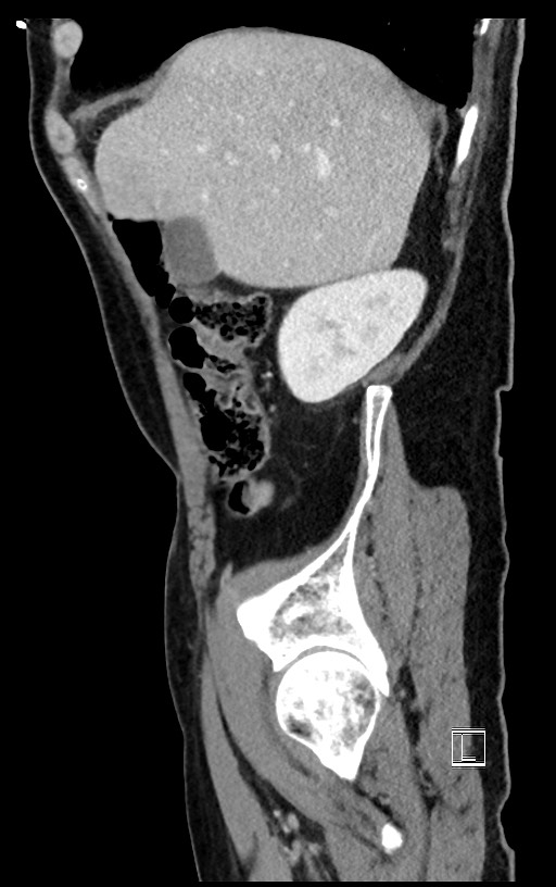 Acute renal infarction (Radiopaedia 59375-66736 Sagittal C+ portal venous phase 46).jpg