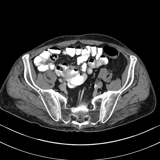 Acute renal infarction - rim capsular enhancement (Radiopaedia 59833-67270 Axial C+ portal venous phase 77).jpg