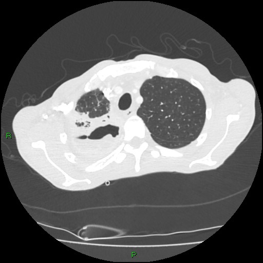 Acute right lung abscess (Radiopaedia 34806-36258 Axial lung window 33).jpg
