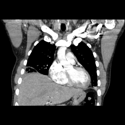 Acute segmental pulmonary emboli and pulmonary infarction (Radiopaedia 62264-70444 Coronal C+ CTPA 15).jpg