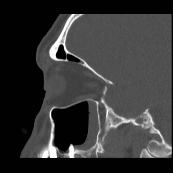Acute sinusitis (Radiopaedia 23161-23215 Sagittal bone window 44).jpg