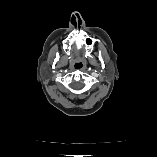 File:Acute subarachnoid hemorrhage and accessory anterior cerebral artery (Radiopaedia 69231-79009 Axial C+ arterial phase 69).jpg