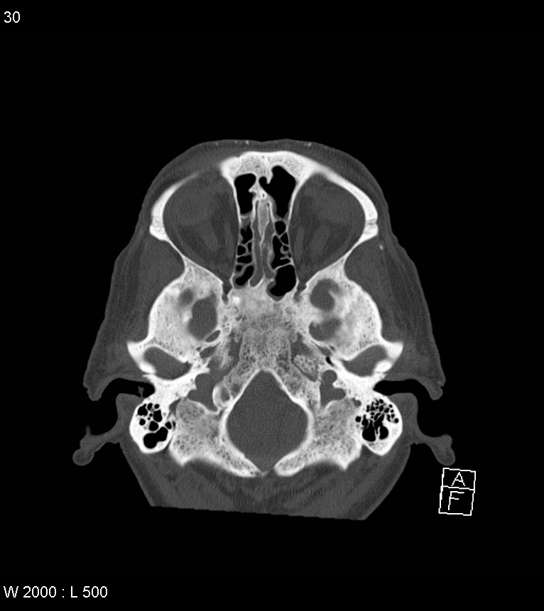 Acute subdural hematoma with myelofibrosis (Radiopaedia 52582-58494 Axial bone window 15).jpg