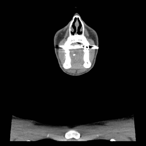 File:Acute submandibular sialadenitis secondary to ductal stone (Radiopaedia 27999-28267 Coronal C+ delayed 11).jpg