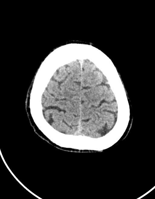 Acute superior cerebellar artery territory infarct (Radiopaedia 84104-99359 Axial non-contrast 15).jpg