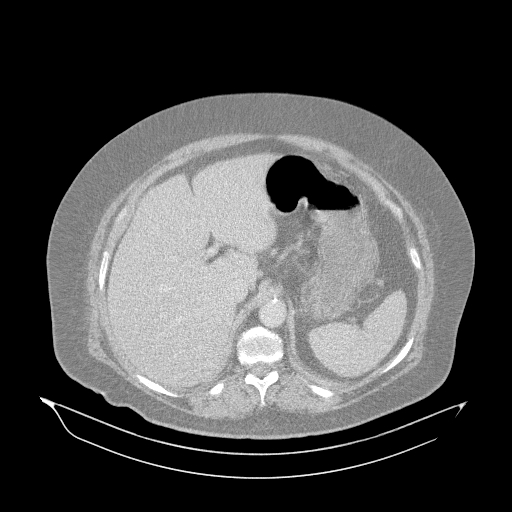 Acute superior mesenteric artery occlusion (Radiopaedia 51288-56960 Axial lung window 5).jpg