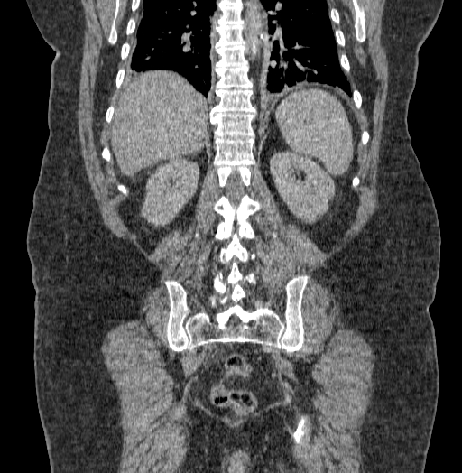 Acute superior mesenteric artery occlusion (Radiopaedia 51288-56960 Coronal C+ portal venous phase 58).jpg