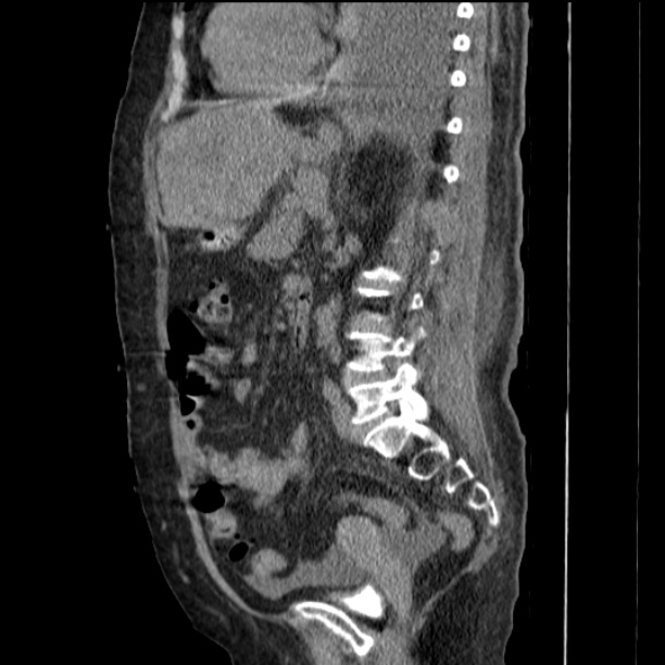 Acute tubular necrosis (Radiopaedia 28077-28334 H 53).jpg