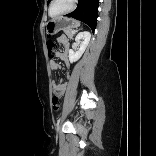 Acute uncomplicated appendicitis (Radiopaedia 73704-84499 Sagittal C+ portal venous phase 137).jpg