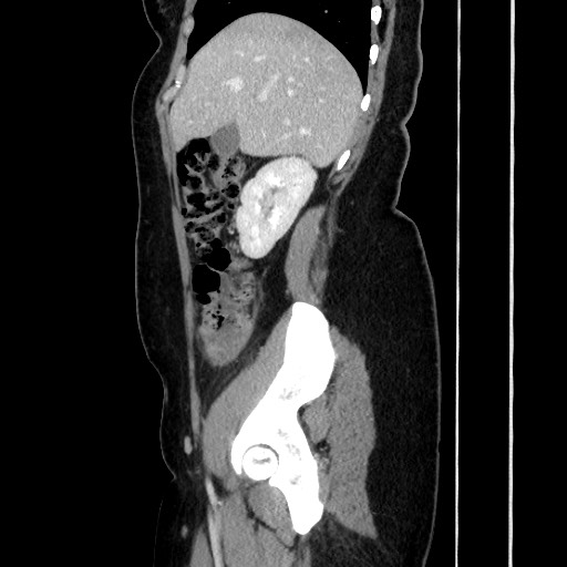 Acute uncomplicated appendicitis (Radiopaedia 73704-84499 Sagittal C+ portal venous phase 76).jpg