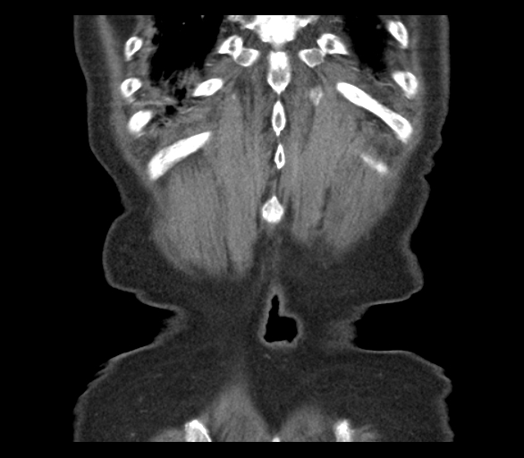 Adenocarcinoma of cecum (Radiopaedia 59222-66549 Axial C+ portal venous phase 5).jpg