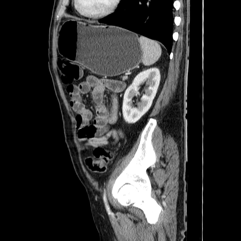 Adenocarcinoma of colon with entero-colic fistula (Radiopaedia 22832-22852 Sagittal C+ portal venous phase 48).jpg