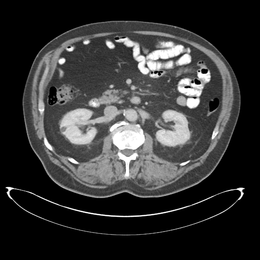 Adenocarcioma of rectum- T1 lesion (Radiopaedia 36921-38547 Axial C+ portal venous phase 37).png