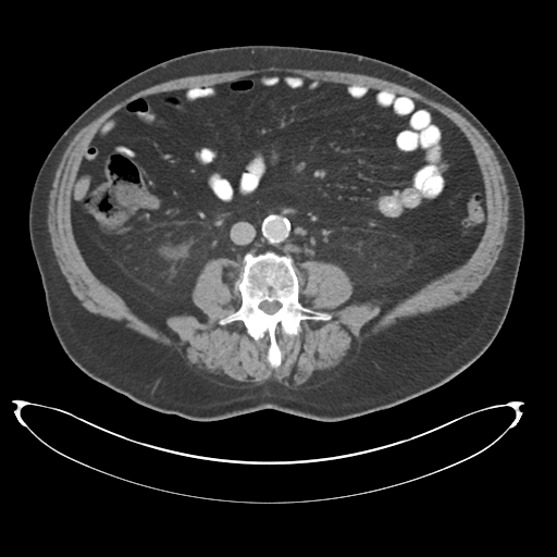 Adenocarcioma of rectum- T1 lesion (Radiopaedia 36921-38547 Axial C+ portal venous phase 48).png