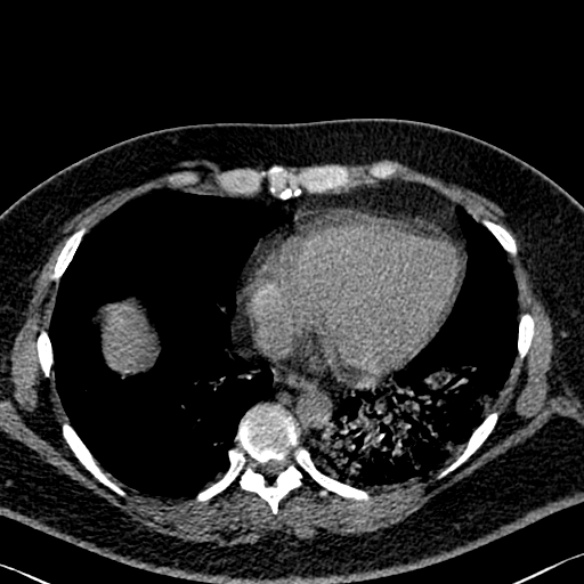 File:Adenoid cystic carcinoma of the trachea (Radiopaedia 49042-54137 Axial non-contrast 244).jpg