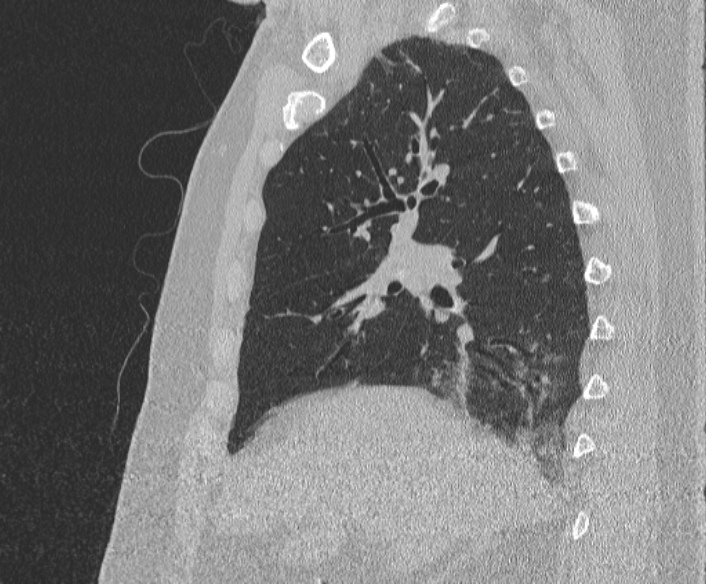Adenoid cystic carcinoma of the trachea (Radiopaedia 49042-54137 Sagittal lung window 173).jpg