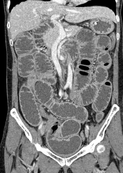 Adhesional small bowel obstruction (Radiopaedia 48397-53305 Coronal C+ portal venous phase 151).jpg
